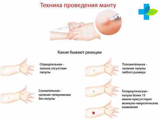 Прививка манту реакции