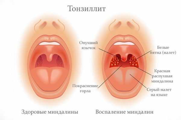 Прививка от тонзиллита