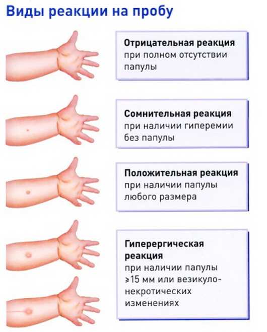 Прививки манту положительная