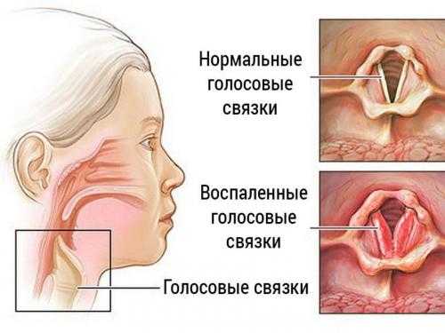 Пропал голос антибиотики