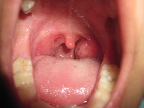 Тонзиллит лечение у взрослых антибиотиками схема