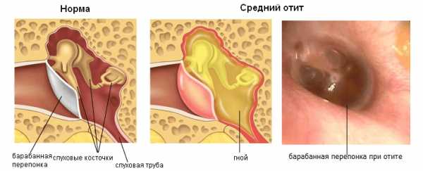 Ушные капли с антибиотиками